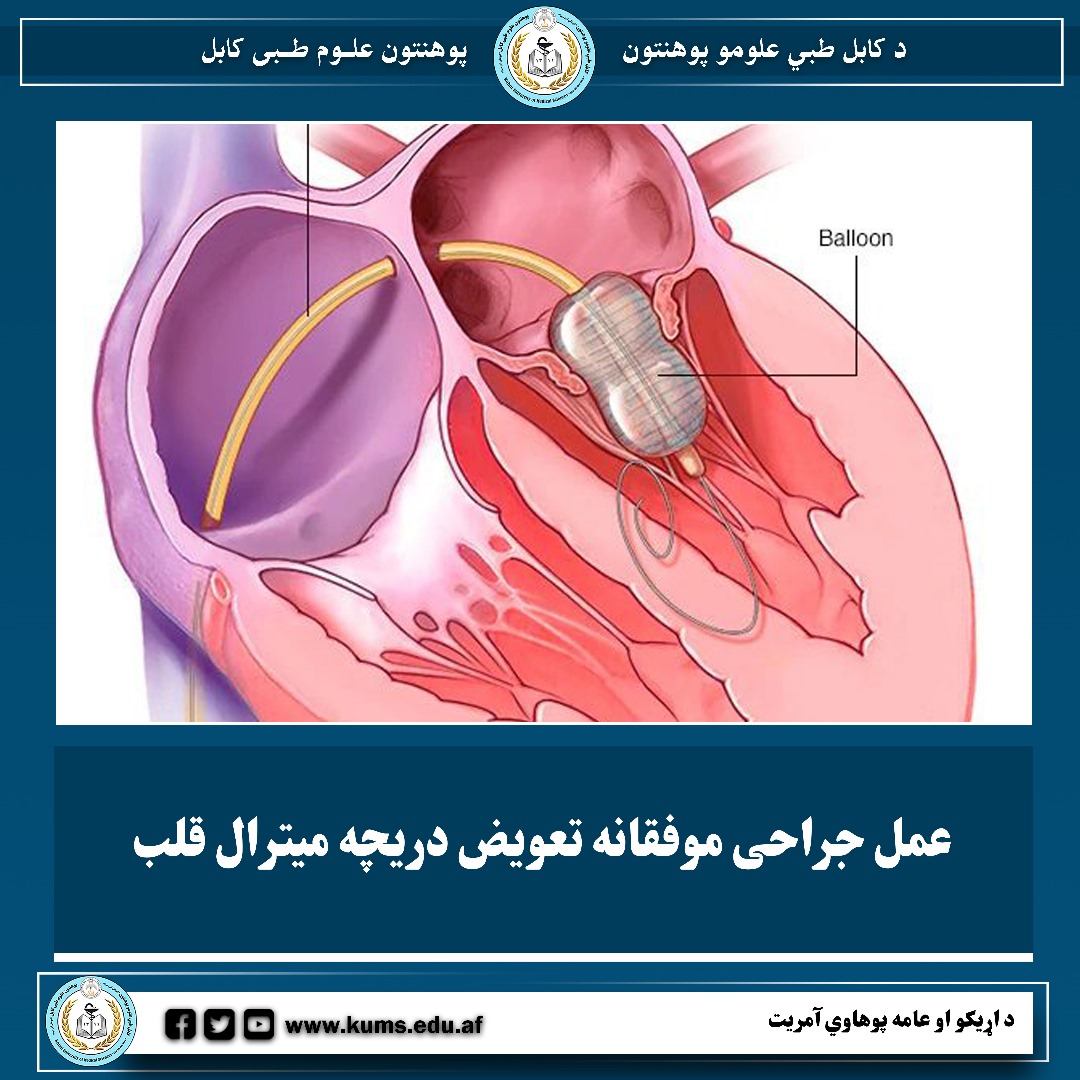 عمل جراحی موفقانه تعویض دریچه میترال قلب