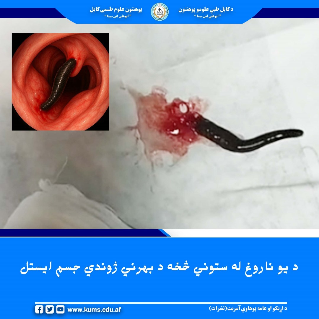 د کابل طبي علومو پوهنتون اړوند میوند تدریسي روغتون د غوږ، ستوني او پزې څانګې ډاګټران د یو بریالي نادر عملیات خبر ورکوي چې پکې د یو ۵۰ کلن ناروغ له ستوني څخه د یو بهرني ژوندي جسم(ژوره) ایستل شوې ده.  