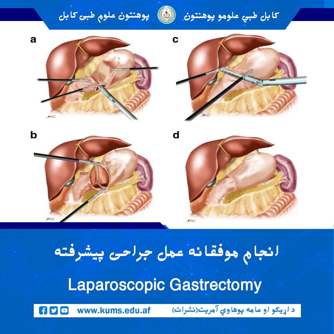 داکتران بخش آنکولوژی شفاخانه تدریسی علیآباد پوهنتون علوم طبی کابل عمل جراحی Laparoscopic Gastrectomy توسط کمره را بالای بیمار ۳۷ ساله که از بندش در قسمت انتهایی معده (Pyloric Obstruction) رنج میبرد، موفقانه انجام داد.
