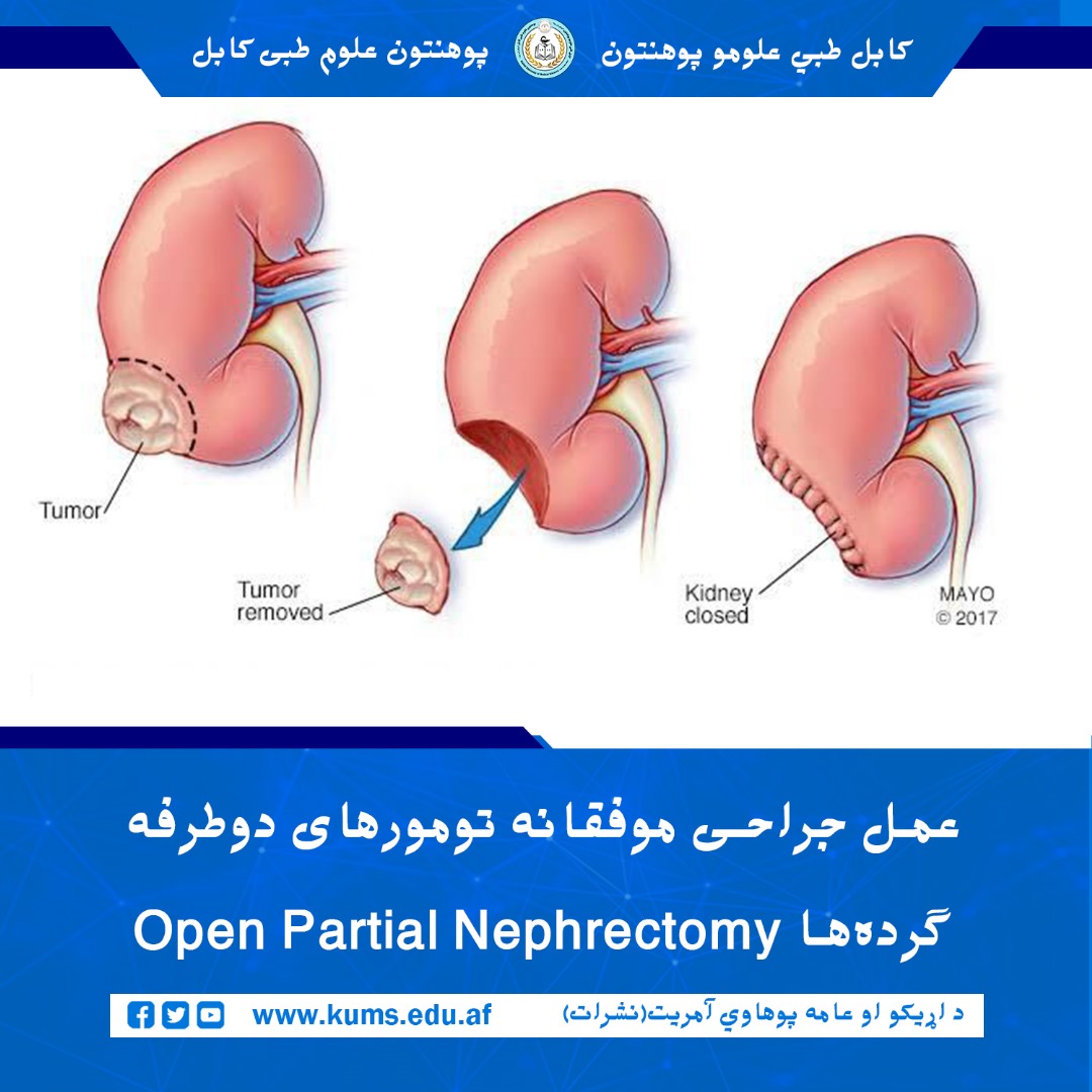 عمل جراحی Open Partial Nephrectomy تحت تکنیک Zero Ischemia بالای بیمار ۶۷ ساله از ولایت هرات که از درد دو طرف بطن شکایت داشت، در بخش جراحی بطنی و آنکولوژی شفاخانه تدریسی علی‌آباد با موفقیت انجام شد.