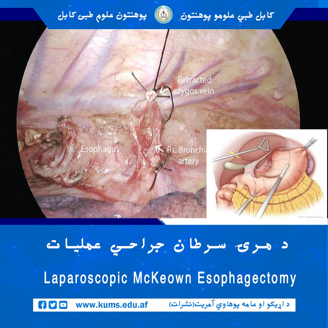 عمل جراحی Laparoscopic McKeown Esophagectomy در بخش آنکولوژی شفاخانه تدریسی علیآباد روی بیماری که از سرطان مری رنج میبرد، موفقانه انجام شد.