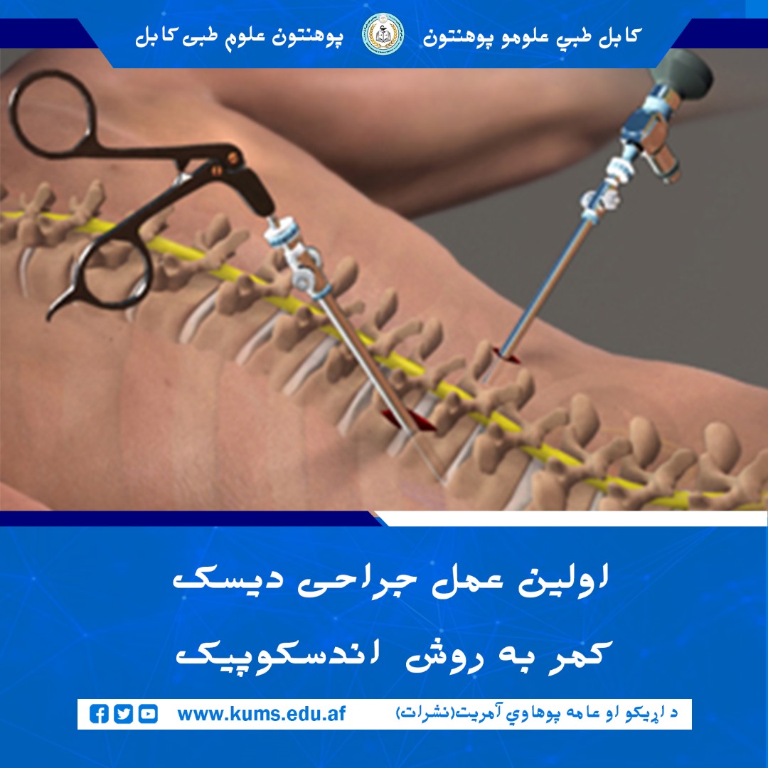 تیم جراحی دیپارتمنت اورتوپیدی شفاخانه تدریسی علیآباد پوهنتون علوم طبی کابل « ابو علی ابن سینا» عمل جراحی به روش Endoscopic Lumbar Discectomy را با موفقیت روی بیمار ۴۰ ساله باشندۀ ولایت بدخشان، انجام داد.