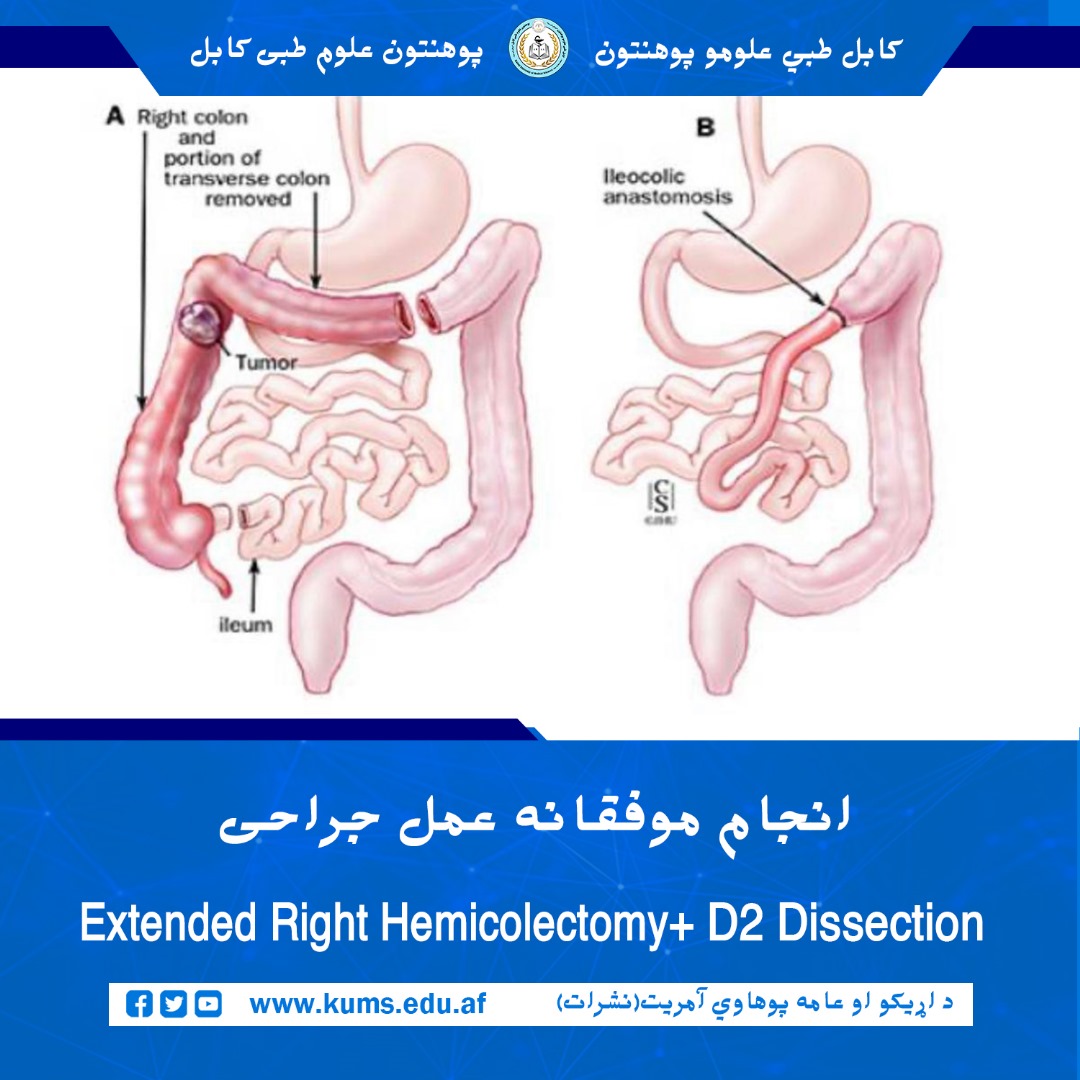 داکتران بخش جراحی بطنی و امراض انکولوژیک شفاخانه تدریسی علیآباد، موفق به انجام یک عمل جراحی شدند که طی آن، یک تومور پیشرفته از قسمت کولون صاعده (Ascending Colon) بیمار ۶۵ ساله با موفقیت برداشته شد.