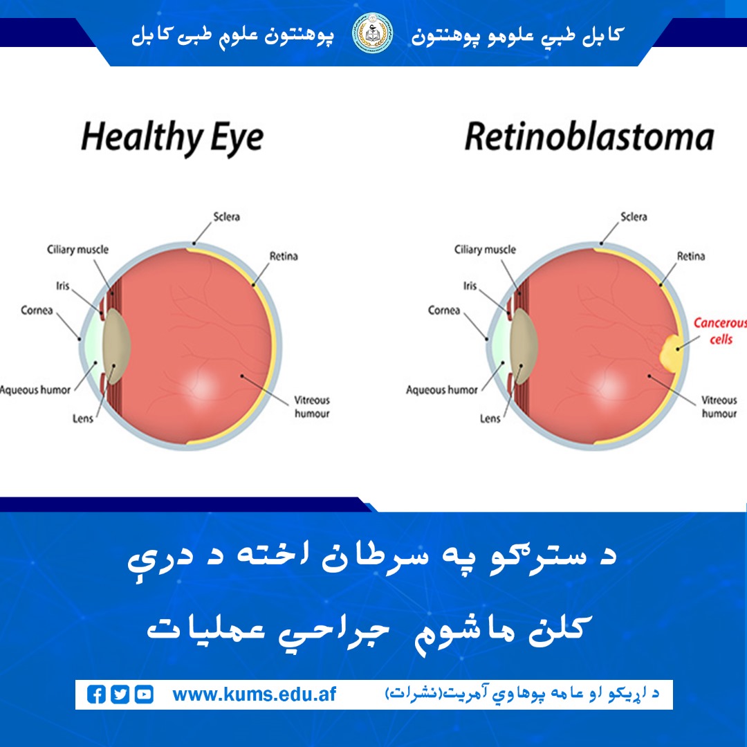 کودک سهساله که از بیماری سرطان چشم (Retinoblastoma) در چشم راست خود رنج میبرد، در شفاخانه تدریسی چشم پوهنتون علوم طبی کابل تحت عمل جراحی موفقانه قرار گرفت.