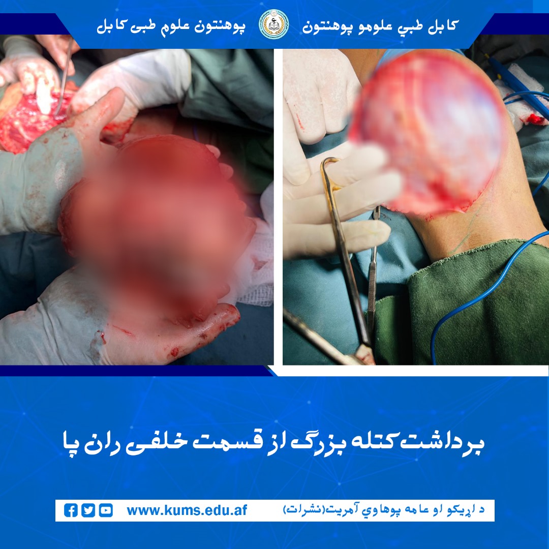 عمل جراحی برداشت تومور از قسمت خلفی( پشت) ران پا راست بیمار ۱۲ ساله توسط داکتران دیپارتمنت جراحی پلاستیک شفاخانه تدریسی میوند پوهنتون علوم طبی کابل«ابوعلی ابن سینا» با موفقیت انجام شد.