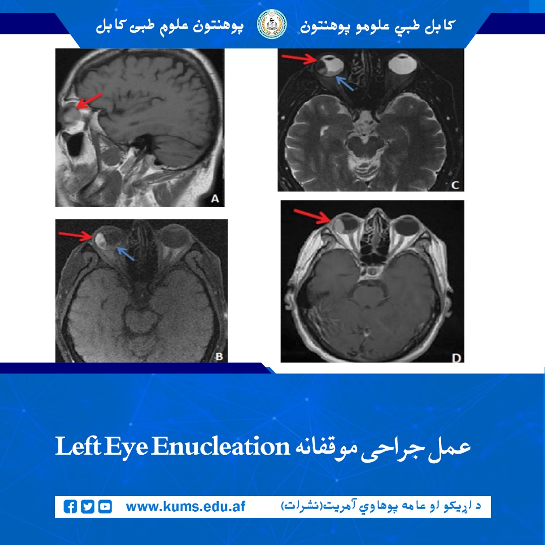 عمل جراحی برداشت کامل سرطان و کره چشم چپ (Left Eye Enucleation) با موفقیت روی بیمار ۵۰ ساله از ولایت بدخشان، توسط داکتران شفاخانه تدریسی چشم پوهنتون علوم طبی کابل «ابو علی ابن سینا»، انجام شد.