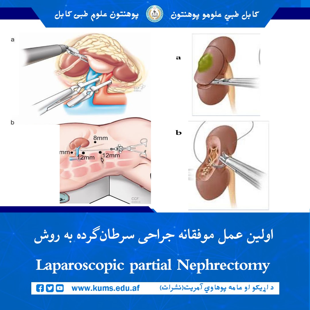 داکتران تیم جراحی دیپارتمنت آنکولوژی شفاخانه تدریسی علی‌آباد پوهنتون علوم طبی کابل « ابو علی ابن سینا» برای اولین بار عمل جراحی سرطان گرده را به شیوه  Laparoscopic partial Nephrectomy روی بیمار ۴۱ ساله با موفقیت انجام داده اند. 