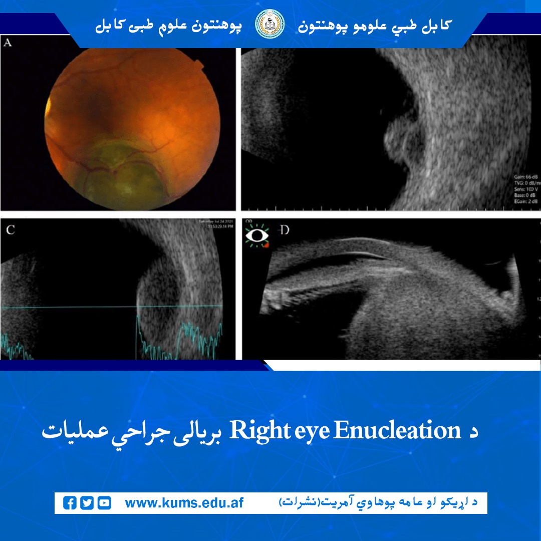 عمل جراحی برداشت کامل کره چشم Enucleation تحت انستیزی عمومی  بالای بیمار ۵۰ ساله از ولایت لوگر، در بخش جراحی شفاخانه تدریسی چشم پوهنتون علوم طبی کابل «ابو علی ابن سینا»  با موفقیت انجام شد. 