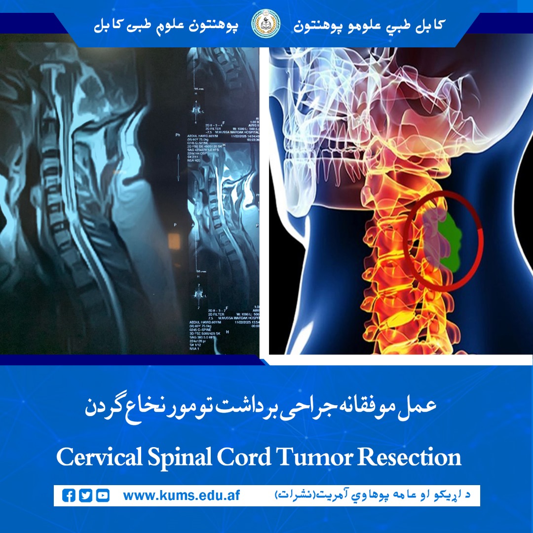 داکتران دیپارتمنت جراحی اعصاب شفاخانه تدریسی علی‌آباد پوهنتون علوم طبی کابل «ابو علی ابن سینا» ، عمل جراحی پیشرفته و حساس برداشت تومور نخاع رقبی (گردنی) (Cervical Spinal Cord Tumor Resection) را با موفقیت انجام دادند. 