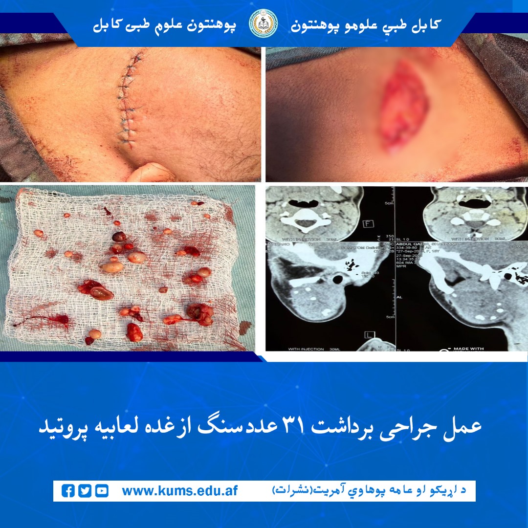 داکتران  دیپارتمنت جراحی وجه و فک شفاخانه تدریسی ستوماتولوژی پوهنتون علوم طبی کابل «ابوعلی ابن‌سینا»  در یک واقعه نادر موفق به کشیدن ۳۱ عدد سنگ از غده لعابیه پروتید بیمار  ۱۷ ساله باشنده ولایت پروان شدند. 