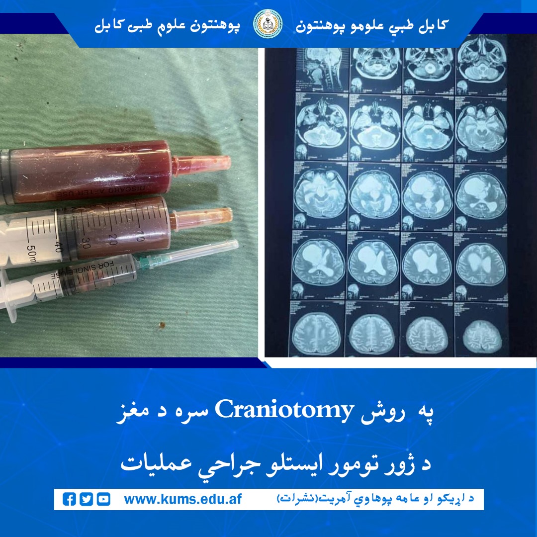 د کابل طبي علومو پوهنتون «ابو علي ابن سینا» اړوند علي آباد تدریسي روغتون د اعصابو جراحي ډيپارټمنټ ډاکټرانو په (Craniotomy and Excision of Sellar and Suprasellar SOL) روش سره د مغز د ژور تومور لرې کولو جراحي عملیات په بریالیتوب ترسره کړ. 