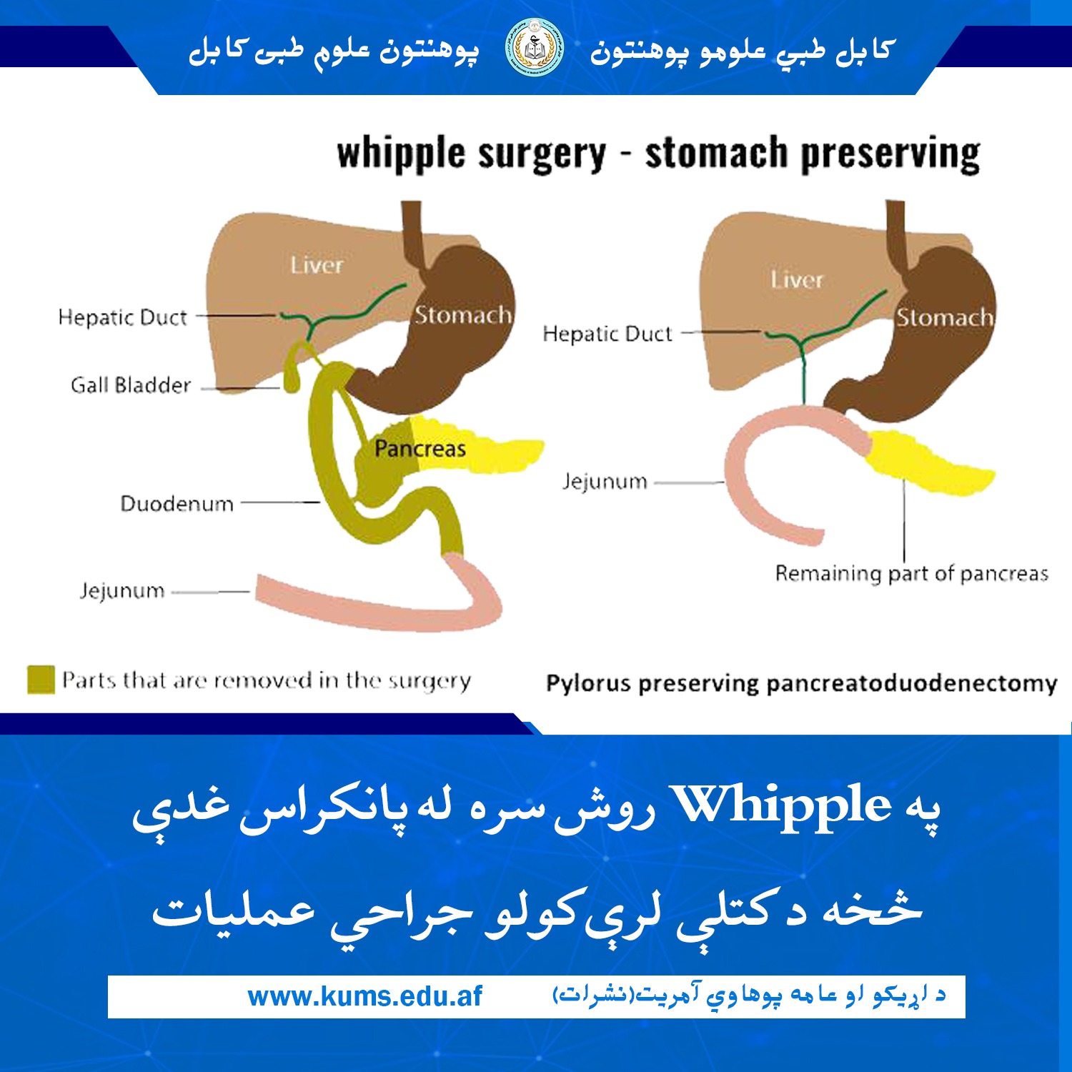 د کابل طبي علومو پوهنتون «ابو علي ابن سینا» اړوند علي آباد تدریسي روغتون د آنکولوژي او بطني جراحي ډيپارټمنټ ډاکټرانو په Whipple روش سره د ننګرهار ولایت اوسېدونکي یو ۴۵ کلن ناروغ د پانکراس پرمختللی جراحي عملیات بریالی ترسره کړ.
