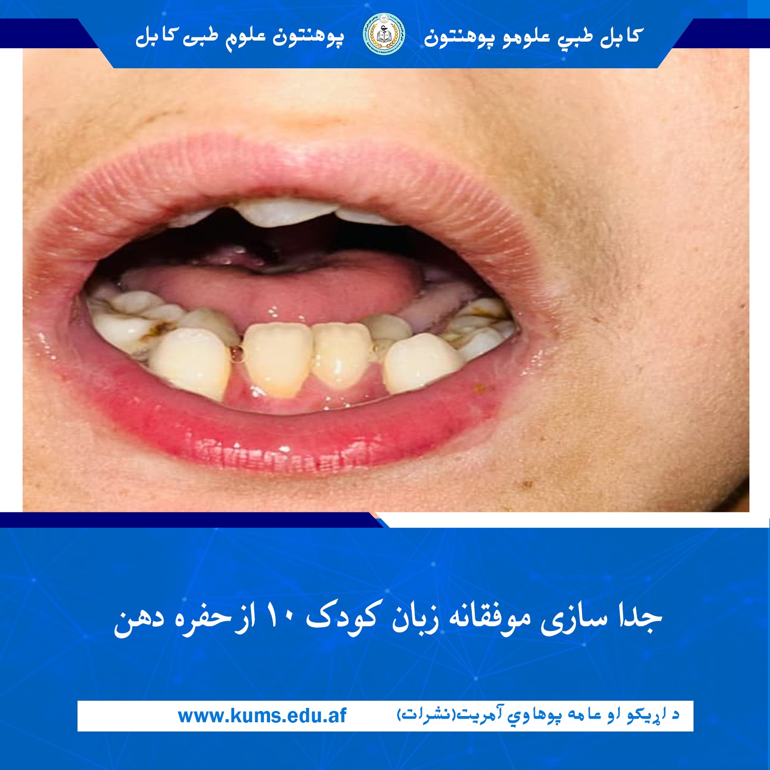 در دیپارتمنت جراحی پلاستیک شفاخانه تدریسی میوند پوهنتون علوم طبی کابل «ابو علی ابن سینا» عمل جراحی آزادسازی زبان یک کودک ۱۰ ساله که به دلیل چسپیدن کامل زبان بشکل مادر زادی با حفره دهان (قسمت پایینی) دچار مشکل در تکلم و حرکت زبان بود، با موفقیت انجام شد.