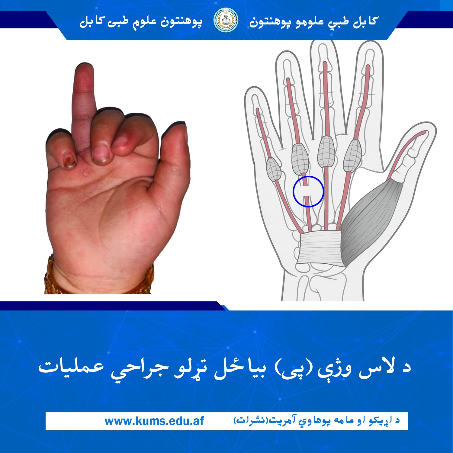 عمل جراحی وصل دوباره تندون (پی ) دست بیمار ۳ ساله توسط داکتران دیپارتمنت جراحی پلاستیک شفاخانه تدریسی میوند پوهنتون علوم طبی کابل« ابو علی ابن سینا» با موفقیت انجام شد. 