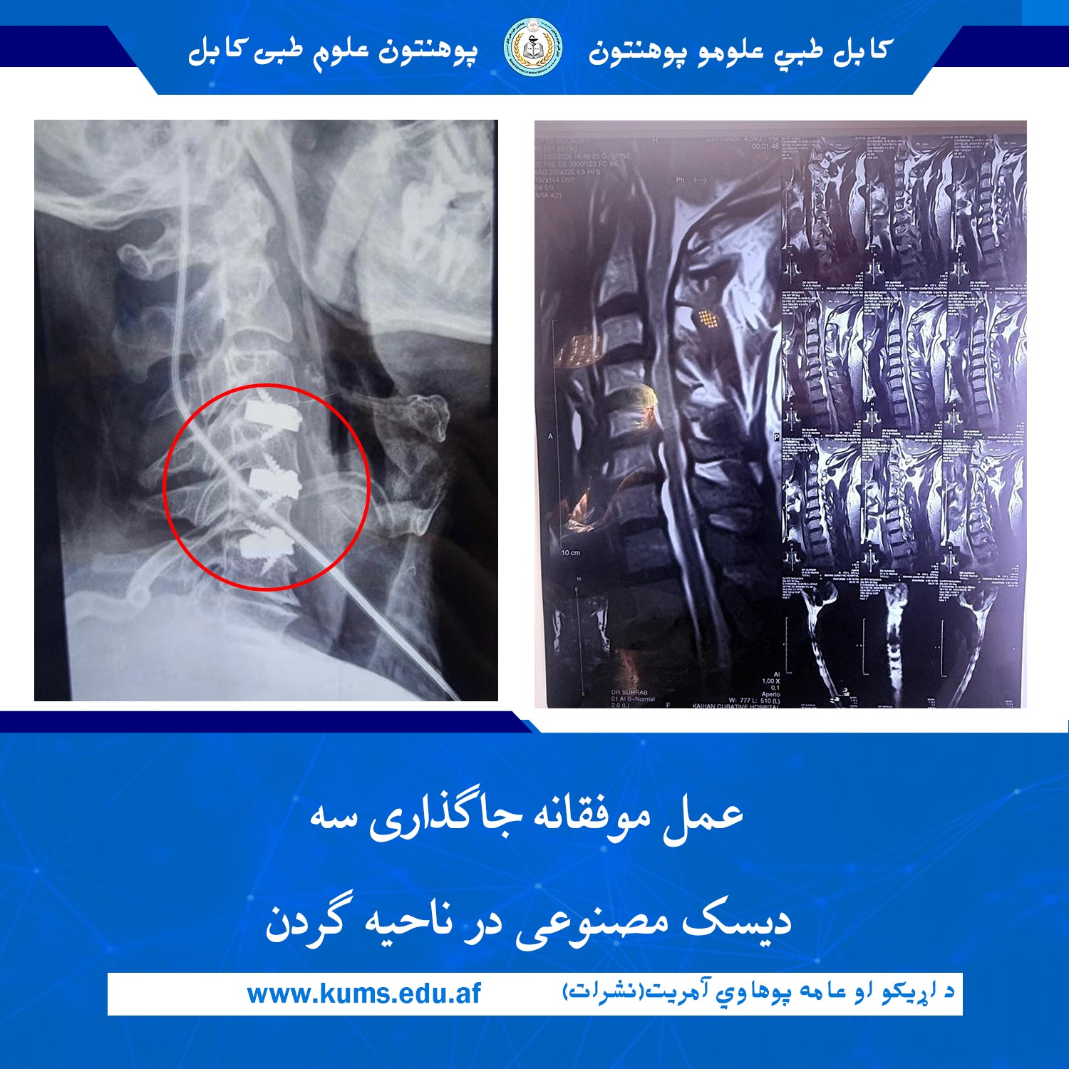 عمل پیچیده و تخصصی تعویض سه دیسک گردن 