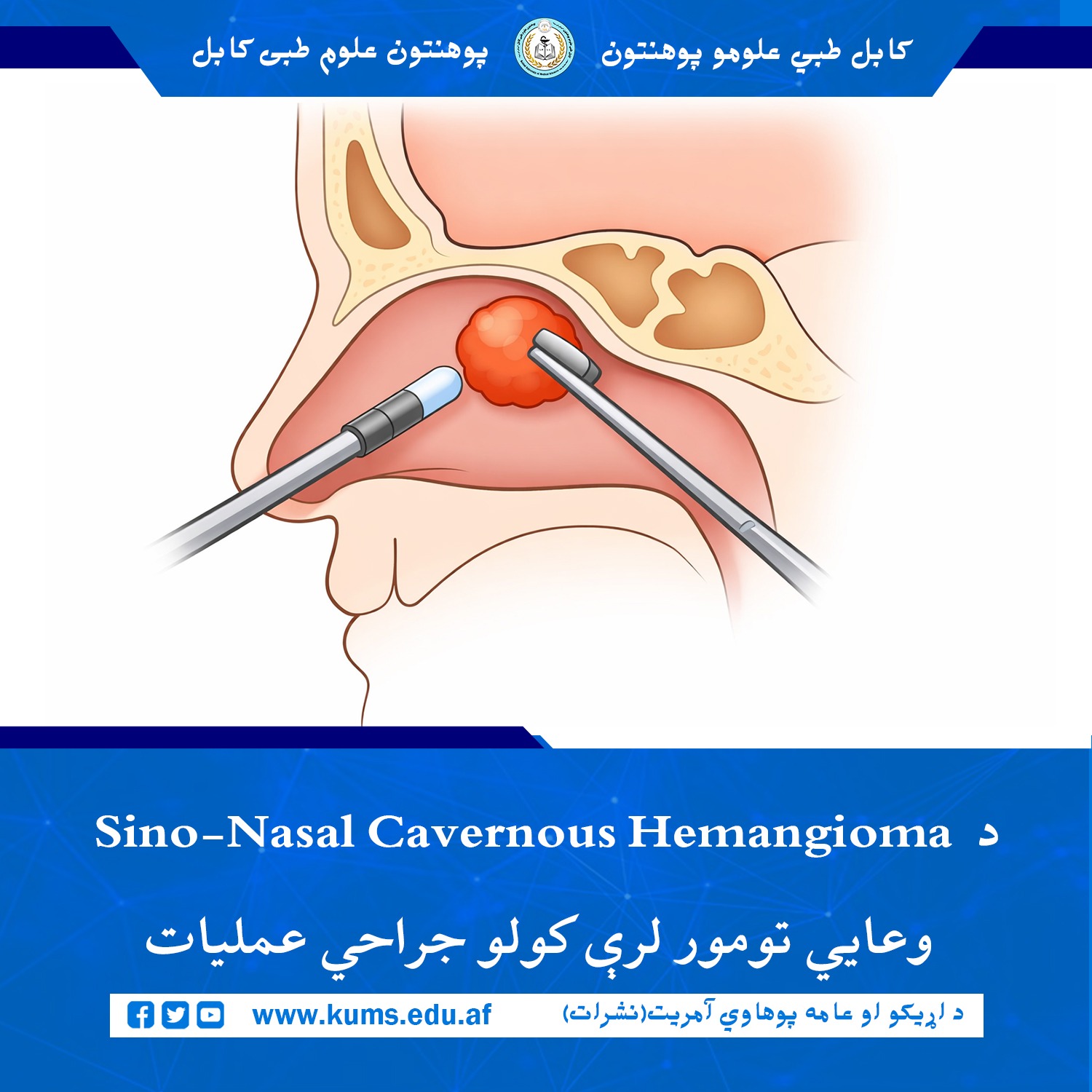 عمل جراحی خارج‌سازی تومور وعایی سینو-نازال (Sino-Nasal Cavernous Hemangioma) در دیپارتمنت گوش، گلو و بینی شفاخانه تدریسی میوند پوهنتون علوم طبی کابل« ابو علی ابن سینا به روش Facial Degloving Approach انجام شد.