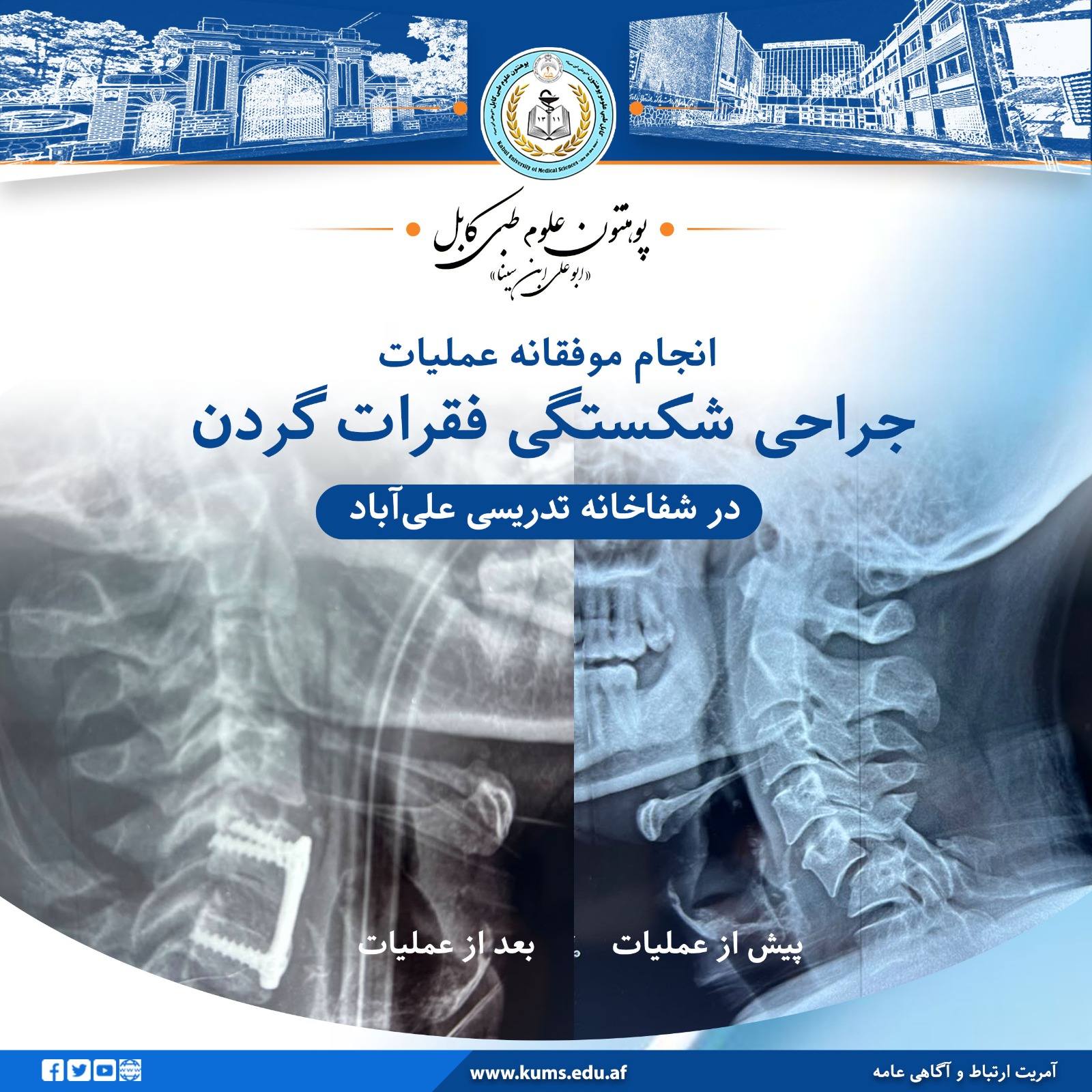 یک عملیات جراحی موفقانه و تخصصی برای تداوی شکستگی فقرات گردن، در دیپارتمنت جراحی اعصاب شفاخانه تدریسی علی‌آباد پوهنتون علوم طبی کابل «ابوعلی ابن‌سینا» انجام شد.